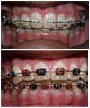 Corrective orthodontics